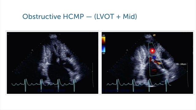 What is mid-ventricular obstruction?