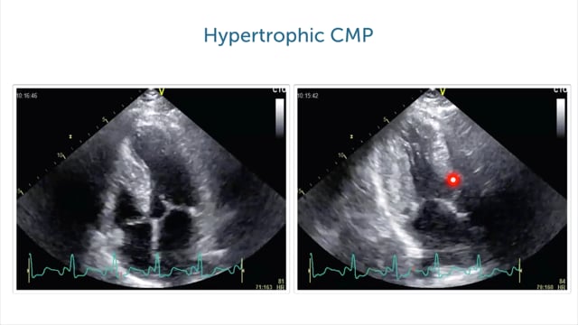 How does fibrosis come together with HCMP?