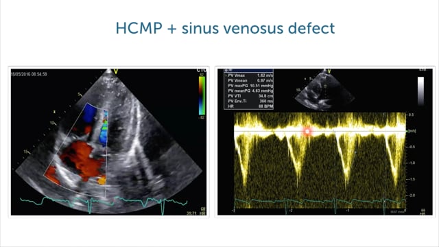 How can RV function be affected in HCMP?