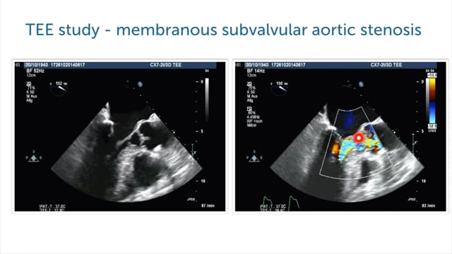 What is the reason for this patient's LVOT obstruction?