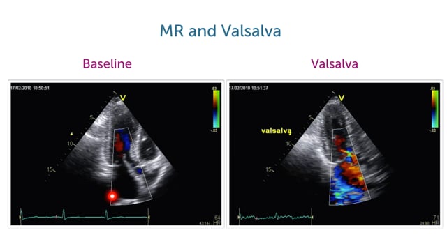 How can the Valsalva maneuver help me to assess obstruction?