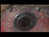 Corneal Graft repair and IOL restabilizing 8-20-19