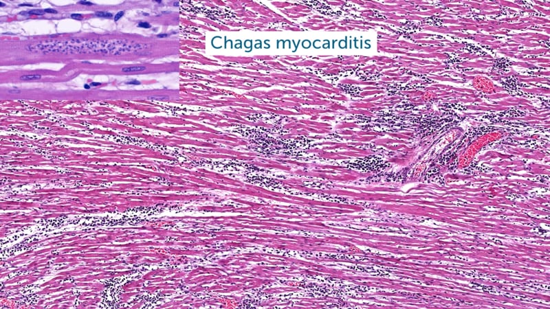 what-are-the-causes-of-cardiomyopathy