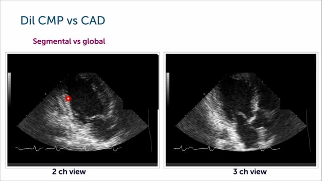 How can I distinguish dilated cardiomyopathy from ischemic cardiomyopathy/CAD?