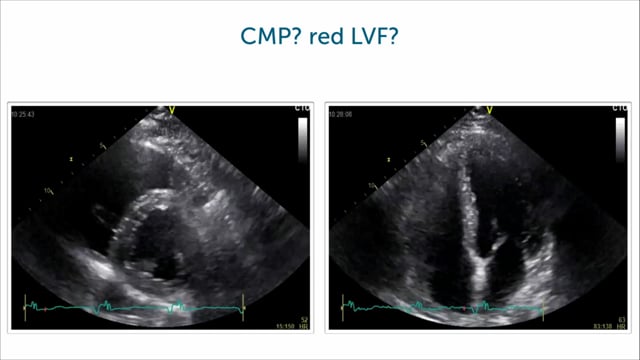 What can echo in cardiomyopathy look like?