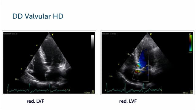 How can I assess cardiomyopathy in patients with a valvular disease?