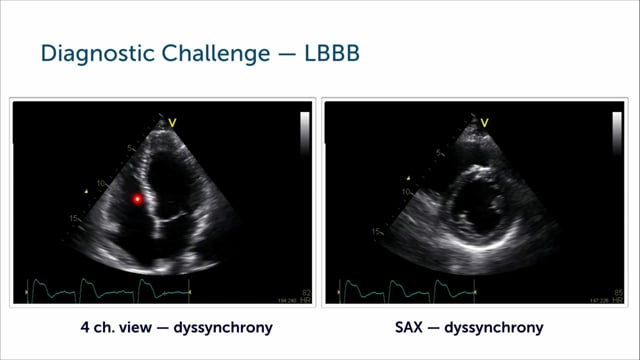 How can I evaluate for cardiomyopathy in patients with LBBB?