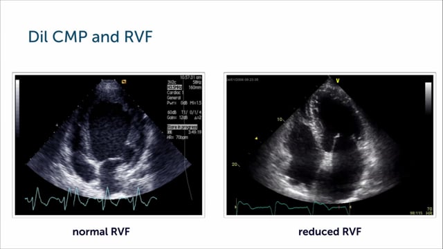 How important is right ventricular function in cardiomyopathy?