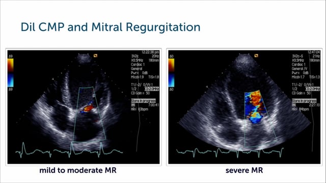 How can I assess diastolic function in cardiomyopathy?