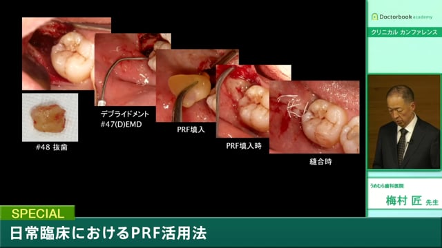 #2 抗血栓療法患者の抜歯