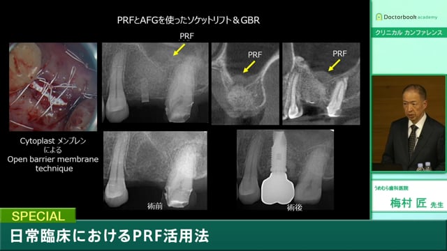 #3 インプラント＆GBRの応用