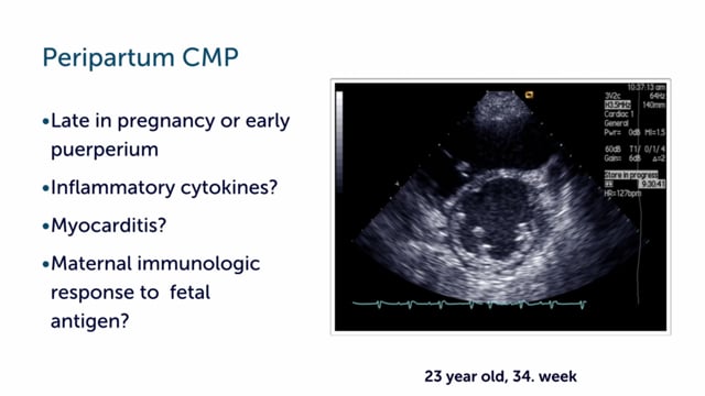 What is peripartum cardiomyopathy?