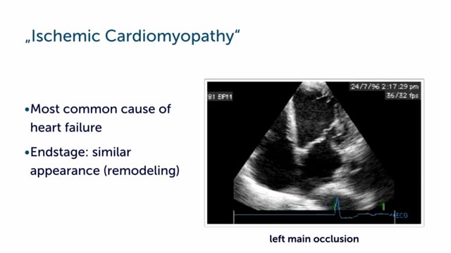 What is ischemic cardiomyopathy?