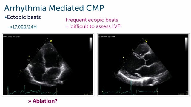 What is arrhythmia associated cardiomyopathy?