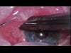Massive Choroidal Hemorrhage 8-23-19