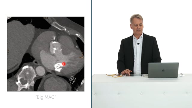 What is stenotic mitral annular calcification?