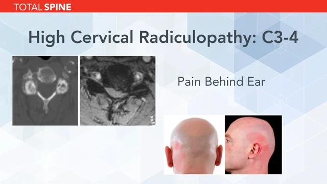 🥇 NYC Cervical Radiculopathy Treatment