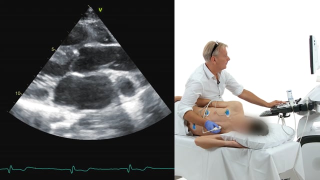 What structures can be seen in the PLAX view?