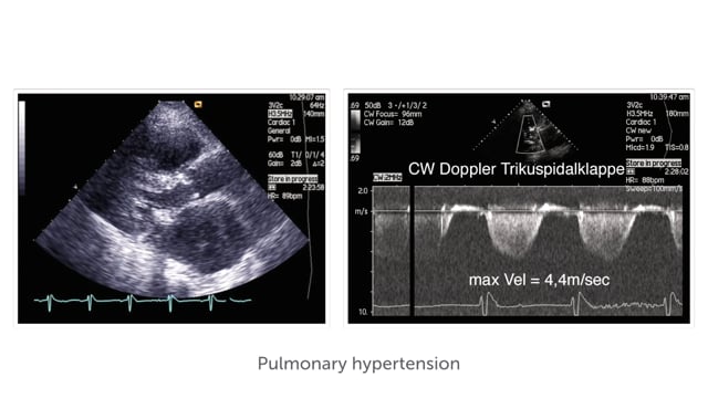 How can MS affect the rest of the heart?