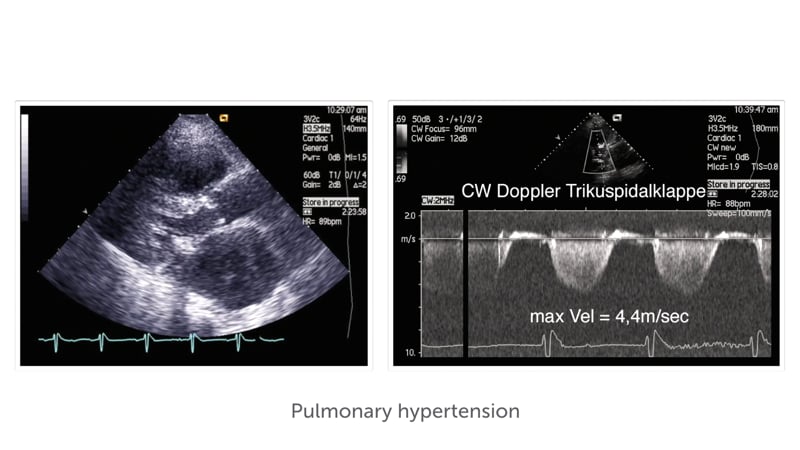 how-can-mitral-stenosis-affect-the-rest-of-the-heart