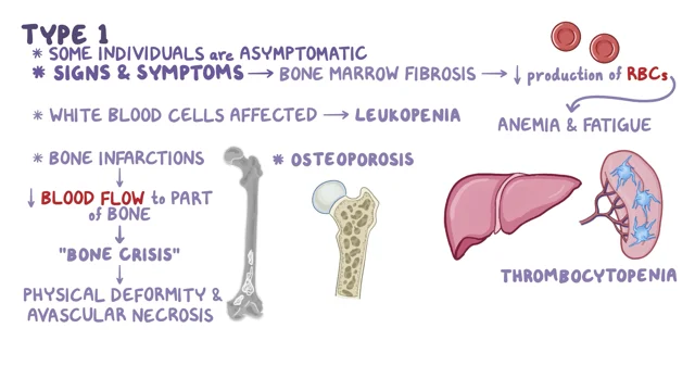 Tay-Sachs Disease: Signs and Symptoms