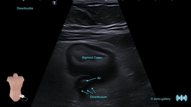 Diverticulitis