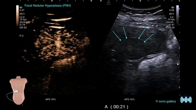 Dromedary Hump of the Left Kidney - SONO.GALLERY