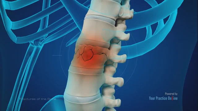 Spine Fracture Treatment Oceanside, Spinal Cord Damage Carlsbad