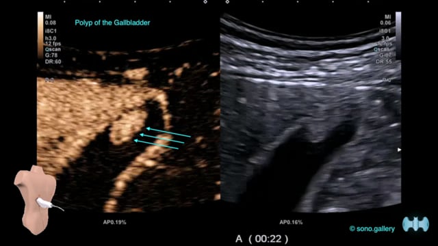 Polyp of the Gallbladder