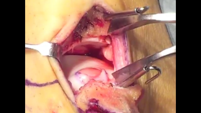 Osteochondral Autograft Transplantation (OATS) of the Talus (no audio)