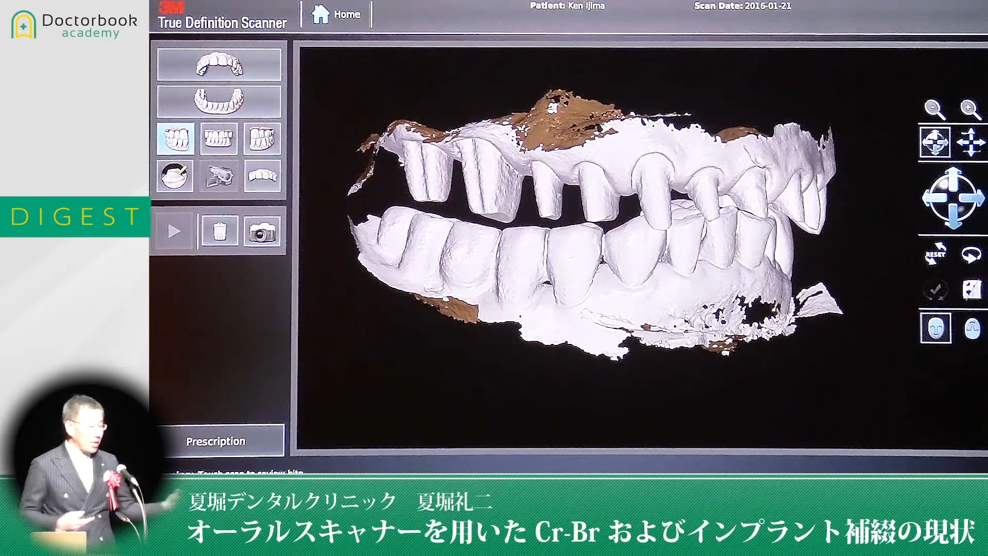 【ダイジェスト】オーラルスキャナーを用いたCr-Brおよびインプラント補綴の現状