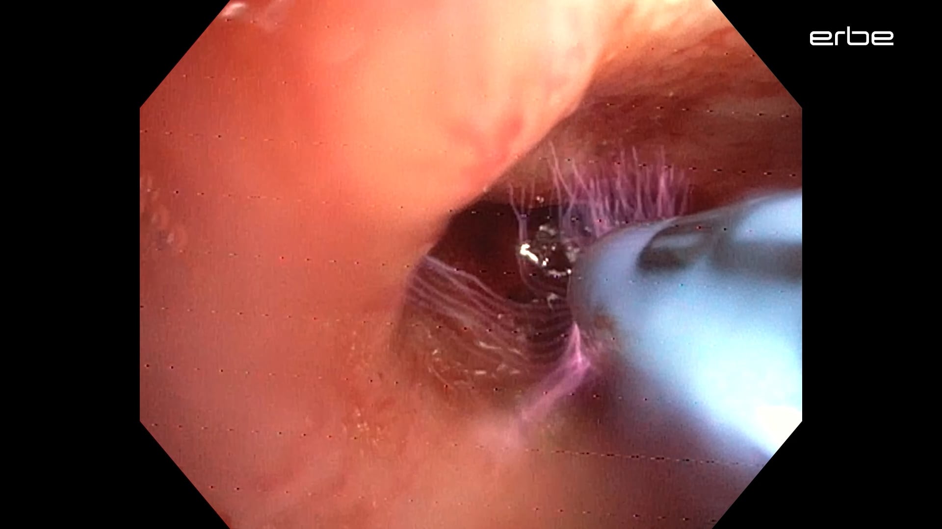 Bleeding management after endobronchial recanalization with flexible FiAPC® probe 1500 A