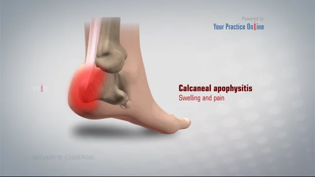 Clinical Practice Guidelines : Apophysitis of the Pelvis and Hip -  Emergency Department