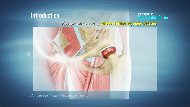 Revision Total Hip Replacement - OrthoInfo - AAOS
