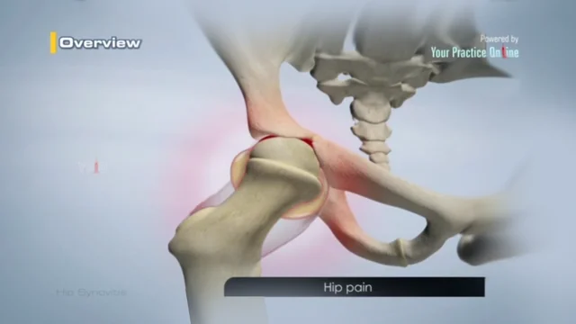 Transient Osteoporosis of The Hip joint Pain