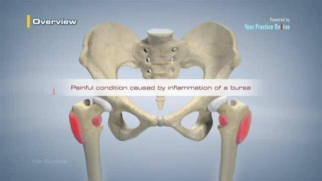 Hip Pain, Hip Arthritis, Hip Bursitis, Hip Impingement