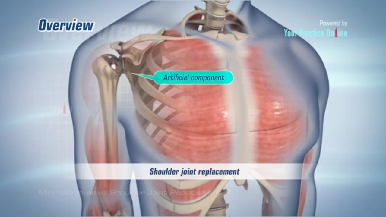 Minimally Invasive Shoulder Joint Replacement Irvine CA | Shoulder 