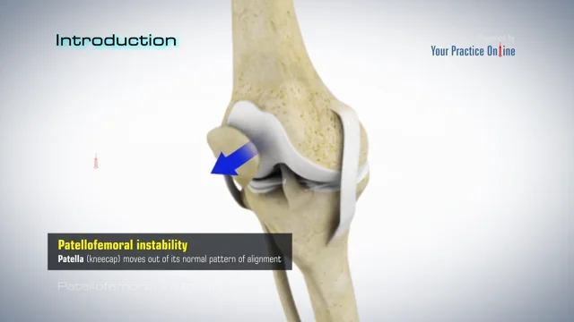 Treatment concept of improving patellar tracking and preventing