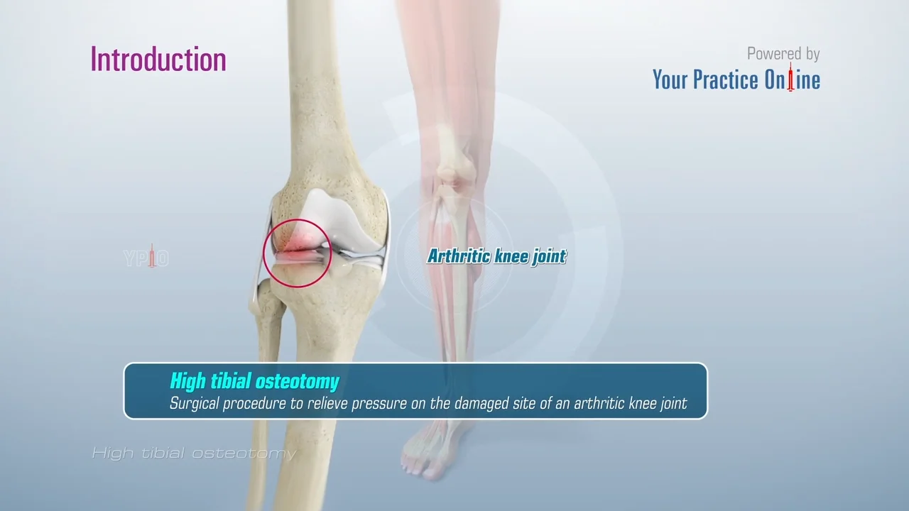 High Tibial Osteotomy Lenexa, KS | Knee Arthritis Treatment Lenexa, KS