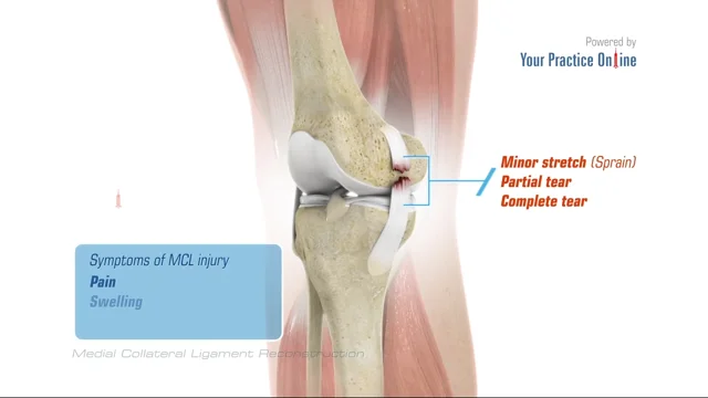 MCL Tear or Medial Collateral Ligament Injuries