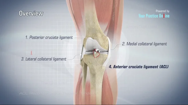 ACL Tear  Orthopedic Centers of Colorado