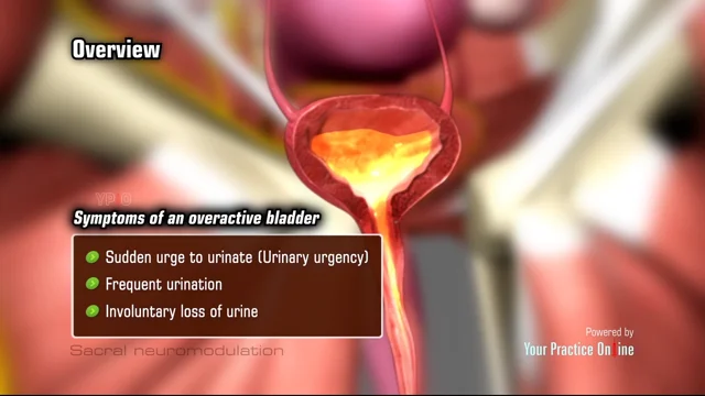 Urinary incontinence: a condition characterized by urine loss