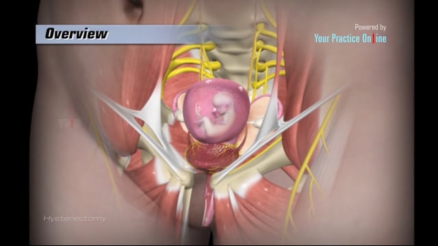 Full Open Tah Sex - Hysterectomy Video | Medical Video Library