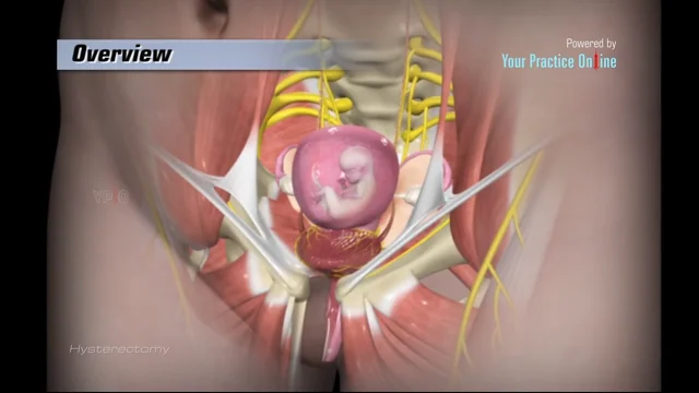 Tummy Support after Hysterectomy  Hysterectomy Recovery Article