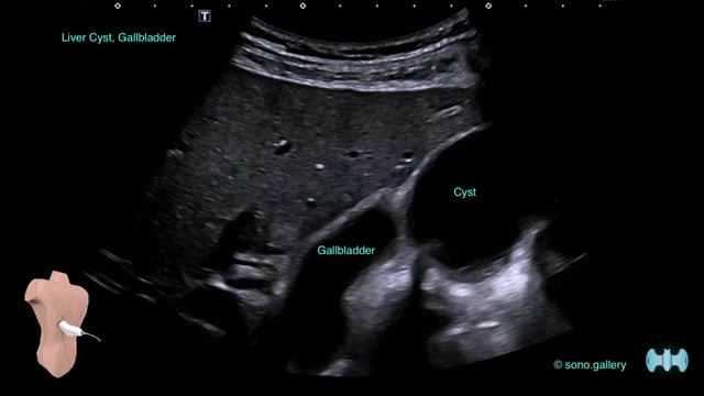 Liver Cyst, Gallbladder