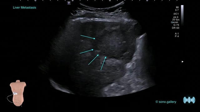 Liver Metastasis