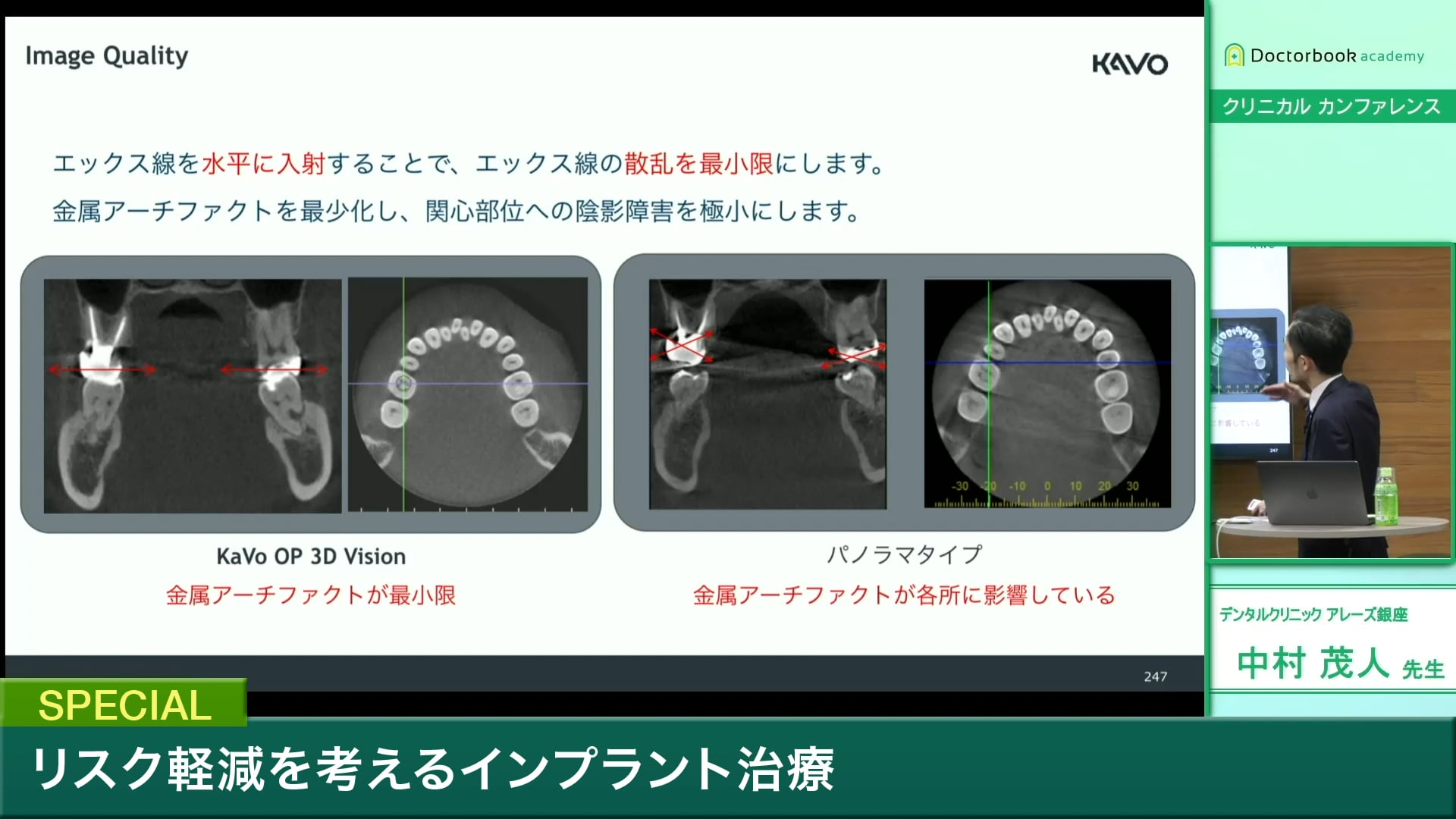 #3 上側切歯抜歯即時埋入症例