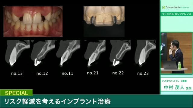 #2 インプラントポジション・アバットメント形態