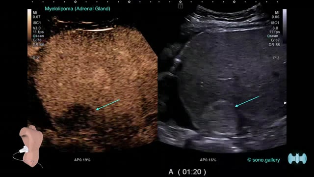 Myelolipoma (Adrenal Gland)