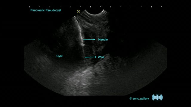 Pancreatic Pseudocyst